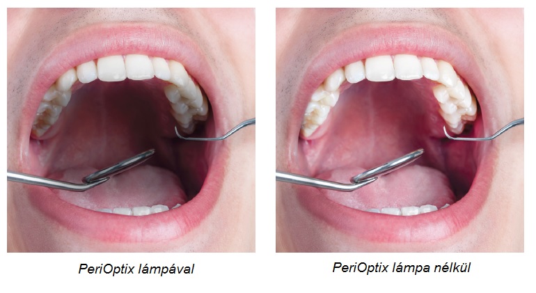 Diagnosztika PeriOptix lampa