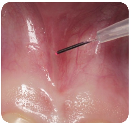 Laser frenectomy 1