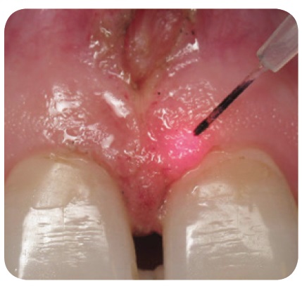 Laser frenectomy 3