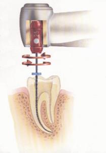 Endo M4 kezidarab