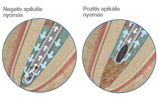 Endo endovactuk