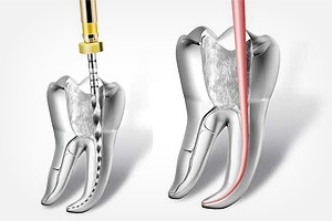 endodoncia1